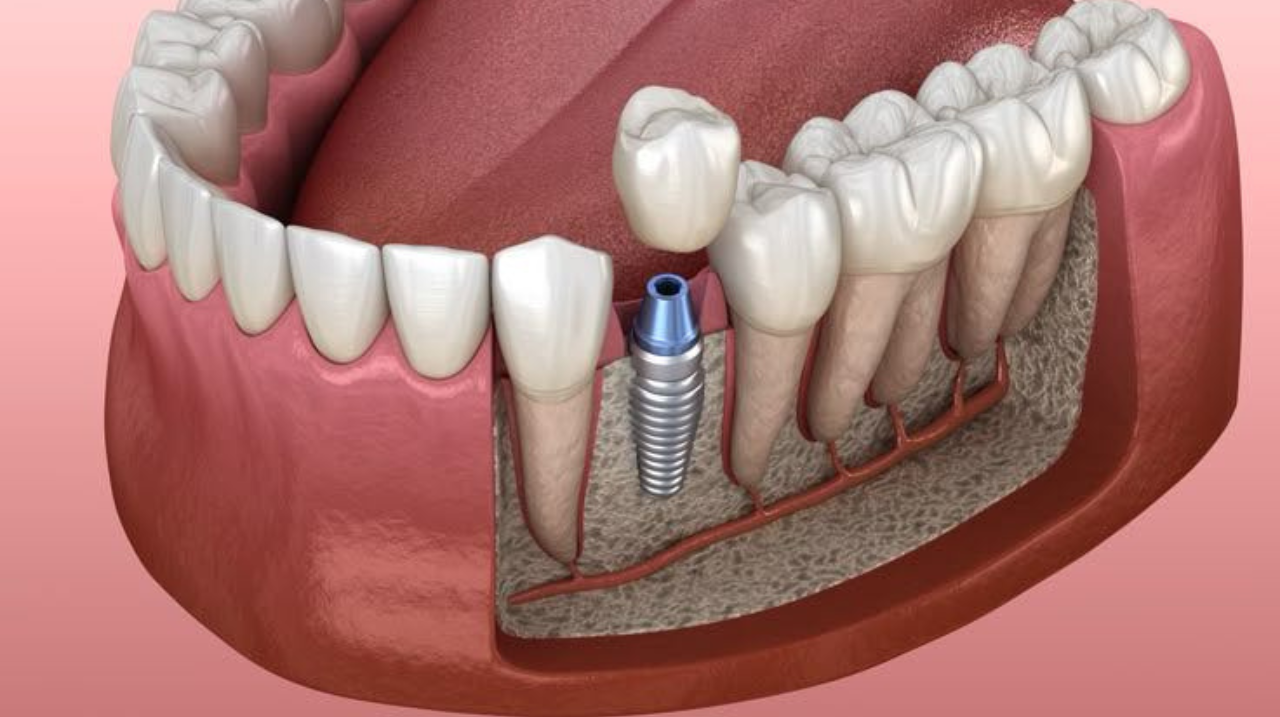 Dental Implants