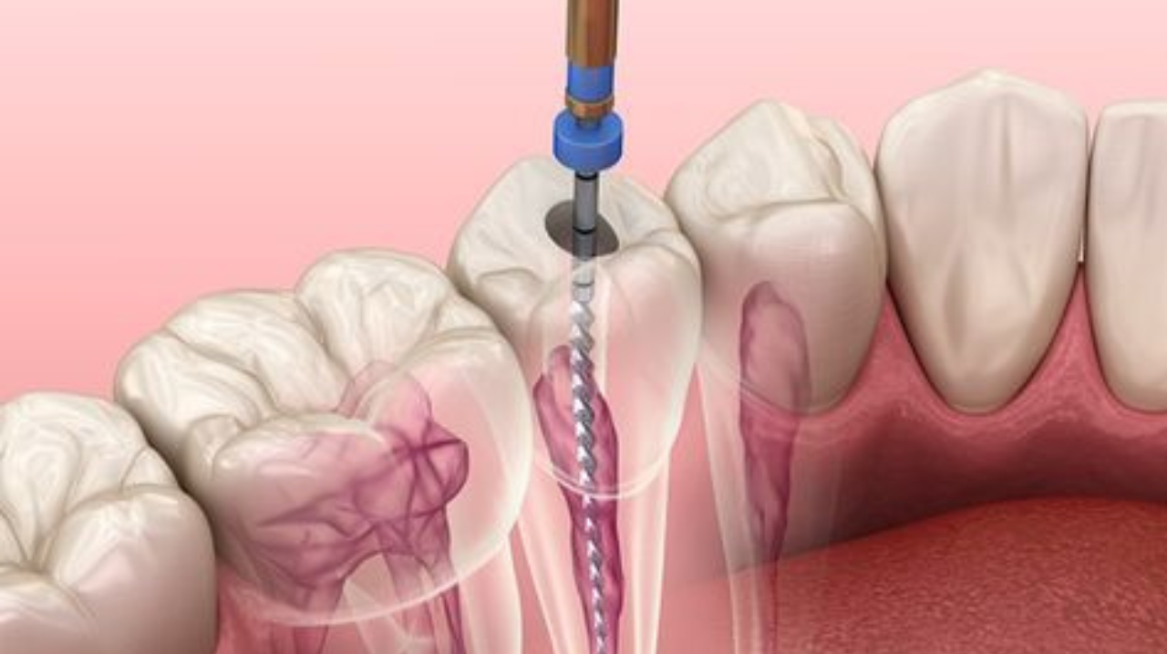 Root Canal Treatment